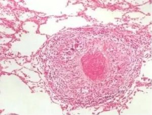 Tuberculosis Microscopy